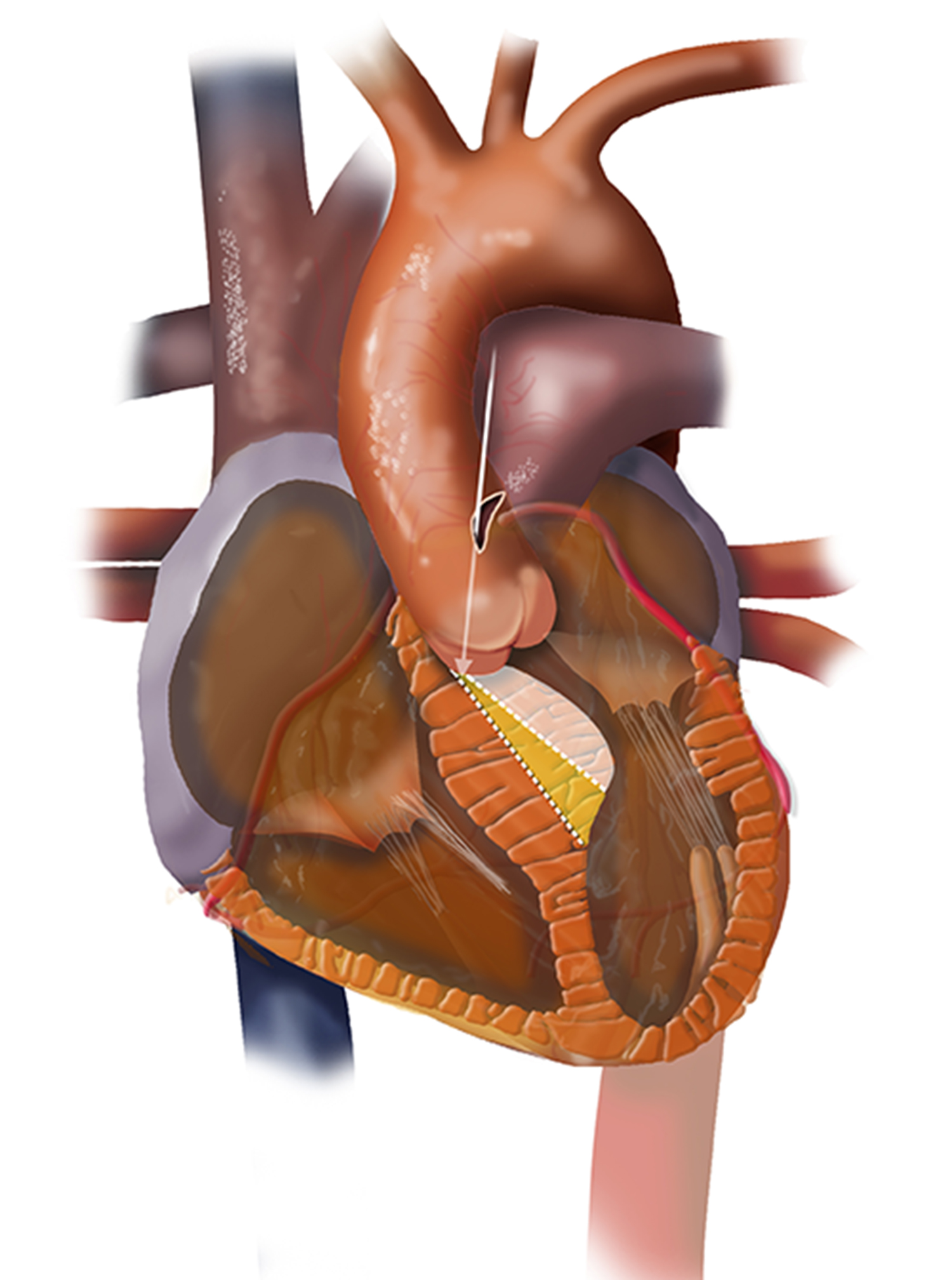 Cut-away view of the heart demonstrating myectomy resection